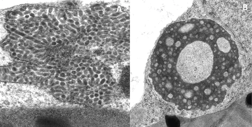 Figura 2 - Micrografia eletrônica de transmissão de parte de uma célula da lesão produzida pela leprose dos citros na folha de laranjeira, causada pelo cilevirus citrus leprosis virus C (CiLV-C). As partículas baciliformes de CiLV-C encontram-se em cavidades do retículo endoplasmático (A). No citoplasma ocorre uma inclusão densa e vacuolada (viroplasma) (B)